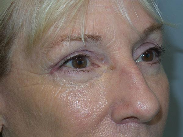 Blepharoplasty Before and After 38 | Grover Aesthetics