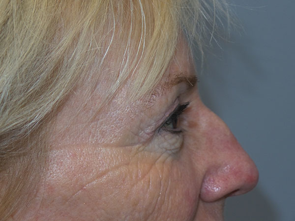 Blepharoplasty Before and After 38 | Grover Aesthetics