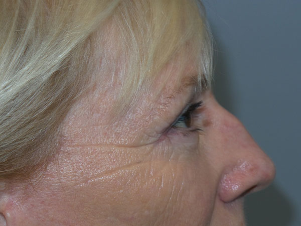 Blepharoplasty Before and After 38 | Grover Aesthetics