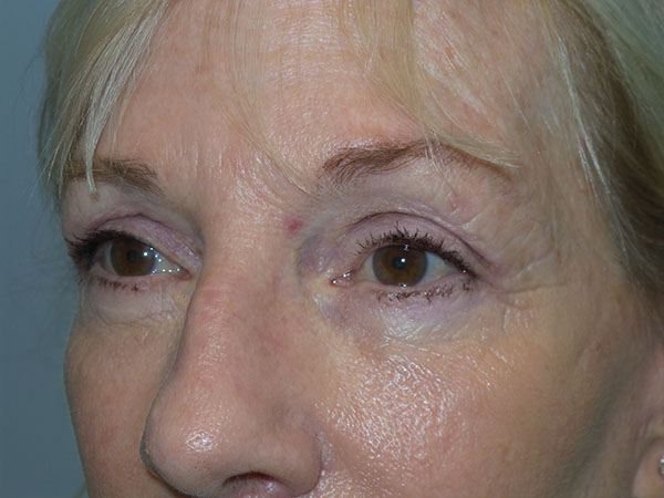 Blepharoplasty Before and After 38 | Grover Aesthetics
