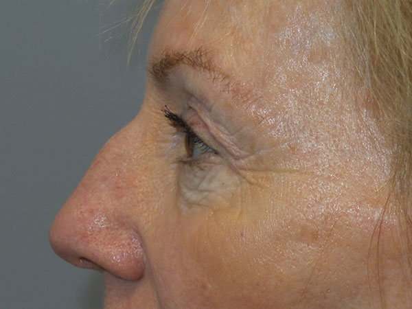 Blepharoplasty Before and After 38 | Grover Aesthetics
