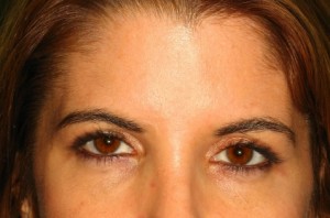Browlift Before and After | Grover Aesthetics