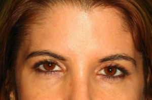 Browlift Before and After 07 | Sanjay Grover MD FACS