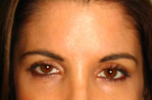 Browlift Before and After | Grover Aesthetics