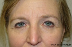 Browlift Before and After 13 | Sanjay Grover MD FACS