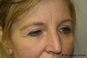 Browlift Before and After 02 | Sanjay Grover MD FACS