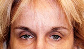 Browlift Before and After | Grover Aesthetics