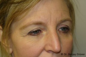 Browlift Before and After 03 | Grover Aesthetics