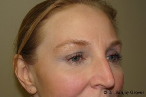 Browlift Before and After 03 | Grover Aesthetics