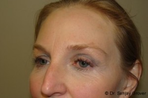 Browlift Before and After 03 | Grover Aesthetics