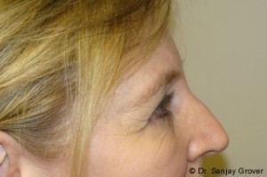 Browlift Before and After 03 | Grover Aesthetics