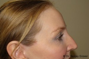 Browlift Before and After 03 | Grover Aesthetics