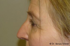 Browlift Before and After 03 | Grover Aesthetics