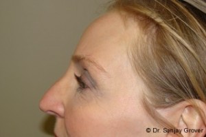 Browlift Before and After 03 | Grover Aesthetics