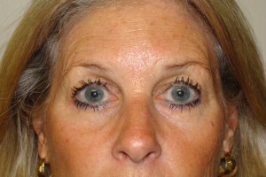 Browlift Before and After 05 | Sanjay Grover MD FACS