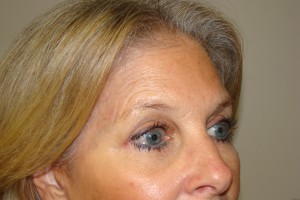 Browlift Before and After 04 | Grover Aesthetics