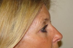 Browlift Before and After 04 | Grover Aesthetics