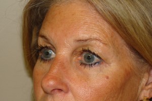 Browlift Before and After 04 | Grover Aesthetics