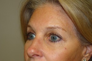 Browlift Before and After 04 | Grover Aesthetics