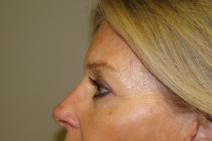 Browlift Before and After 04 | Grover Aesthetics