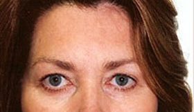 Browlift Before and After | Grover Aesthetics