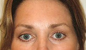 Browlift Before and After | Grover Aesthetics