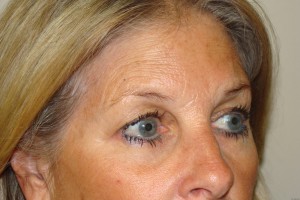 Browlift Before and After 05 | Grover Aesthetics