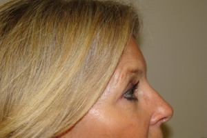 Browlift Before and After 05 | Grover Aesthetics