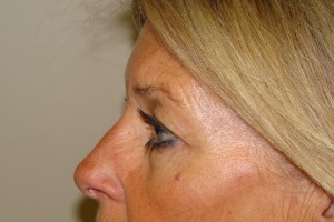 Browlift Before and After 05 | Grover Aesthetics