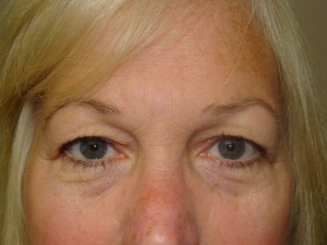 Browlift Before and After 09 | Sanjay Grover MD FACS