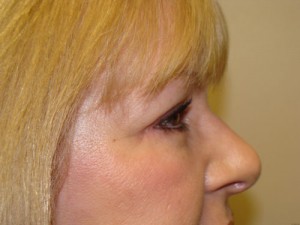 Browlift Before and After 07 | Grover Aesthetics