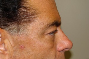 Browlift Before and After 08 | Sanjay Grover MD FACS