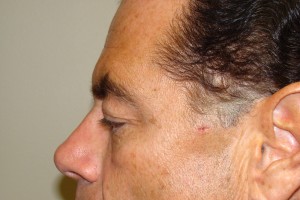 Browlift Before and After 08 | Sanjay Grover MD FACS