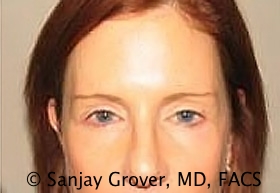 Browlift Before and After 09 | Sanjay Grover MD FACS