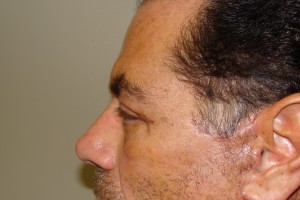 Browlift Before and After 09 | Grover Aesthetics