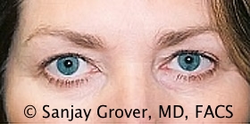 Browlift Before and After 08 | Sanjay Grover MD FACS