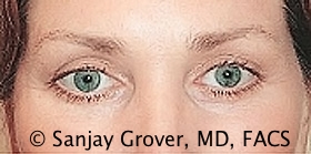 Browlift Before and After 10 | Sanjay Grover MD FACS