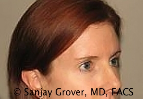 Browlift Before and After 10 | Grover Aesthetics