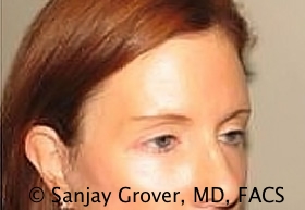 Browlift Before and After 10 | Grover Aesthetics