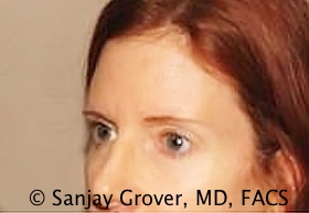 Browlift Before and After 10 | Grover Aesthetics