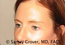 Browlift Before and After 10 | Grover Aesthetics