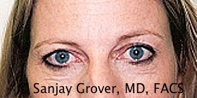 Browlift Before and After 04 | Sanjay Grover MD FACS