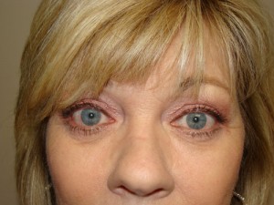 Browlift Before and After | Grover Aesthetics