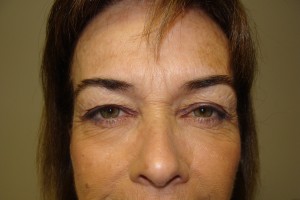 Browlift Before and After 03 | Sanjay Grover MD FACS