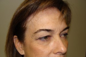 Browlift Before and After 15 | Grover Aesthetics