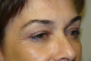 Browlift Before and After 15 | Grover Aesthetics