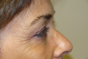 Browlift Before and After 15 | Sanjay Grover MD FACS