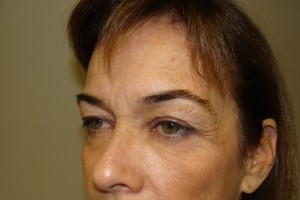 Browlift Before and After 15 | Grover Aesthetics