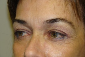 Browlift Before and After 15 | Grover Aesthetics