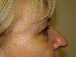 Browlift Before and After 16 | Sanjay Grover MD FACS